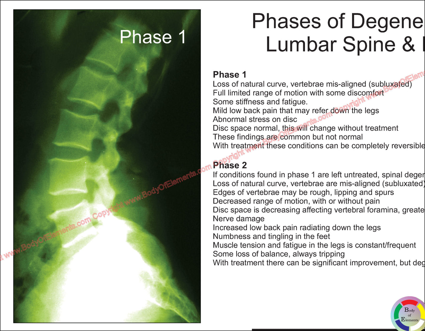 Lumbar Spinal Degeneration Phases Poster