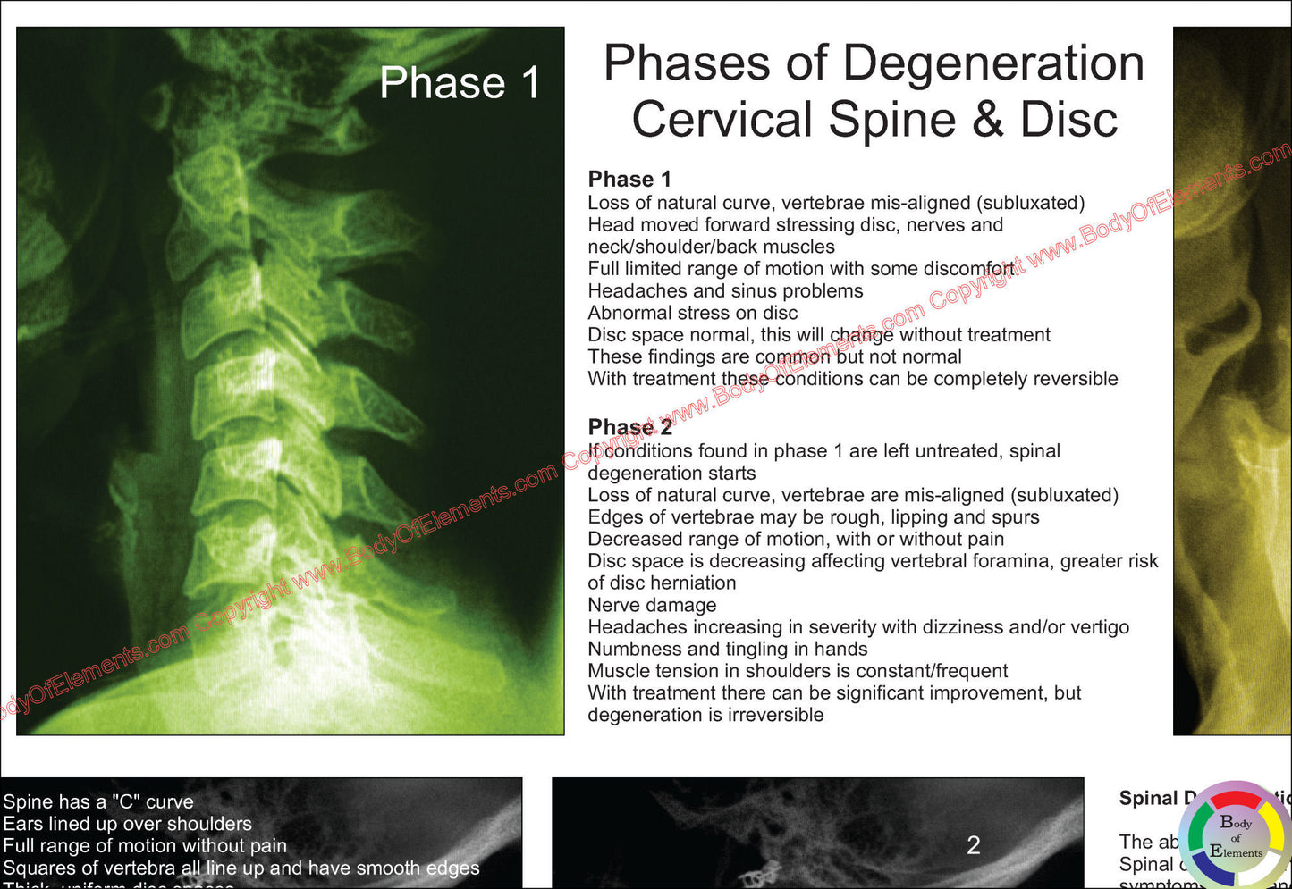 Spinal Degeneration Poster Cervical and Lumbar Spine