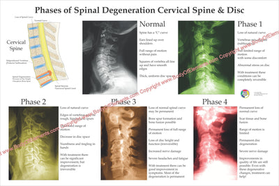 Spinal Degeneration Subluxation Poster Cervical Spine