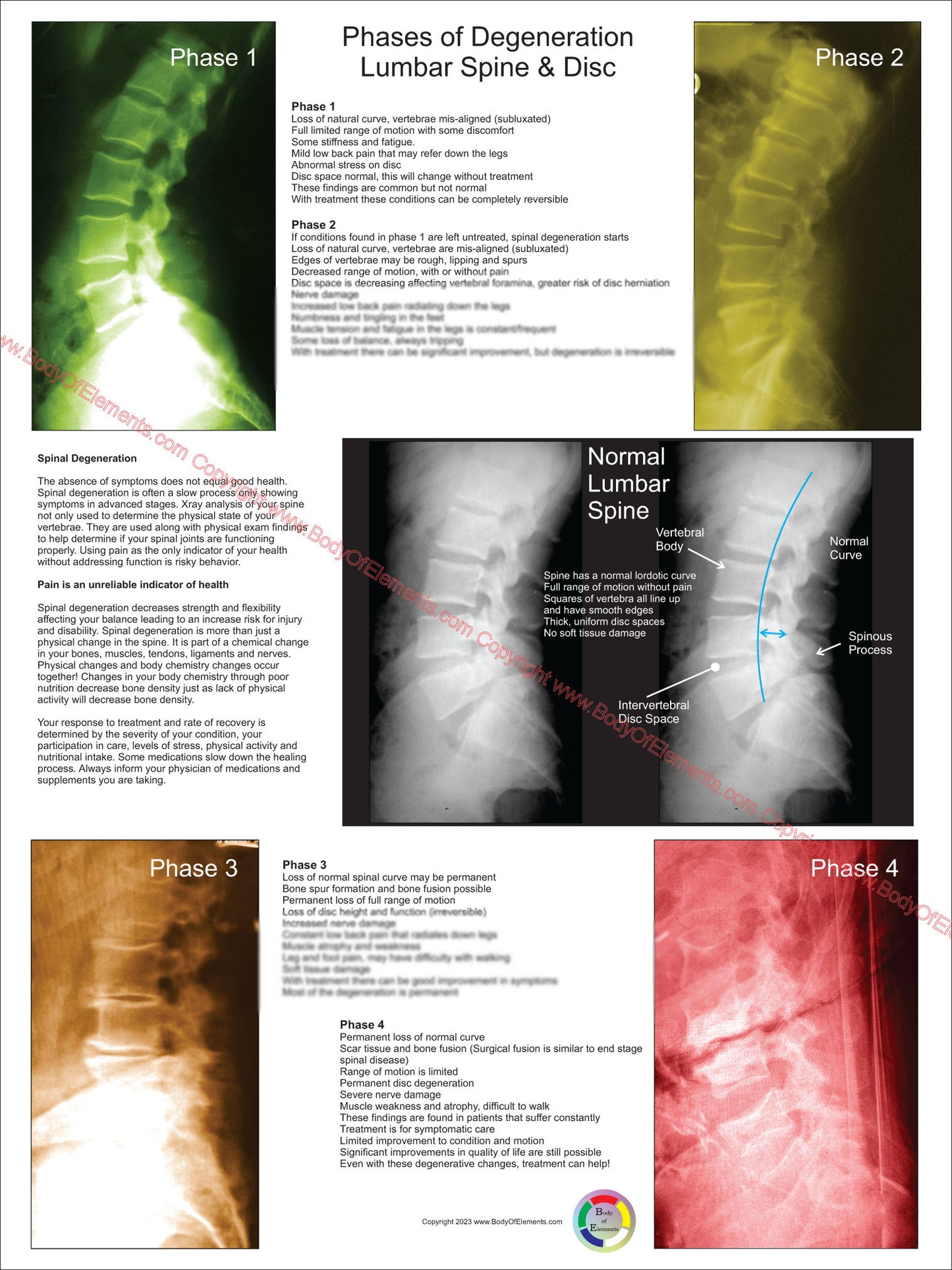 Lumbar Spinal Degeneration Phases Poster