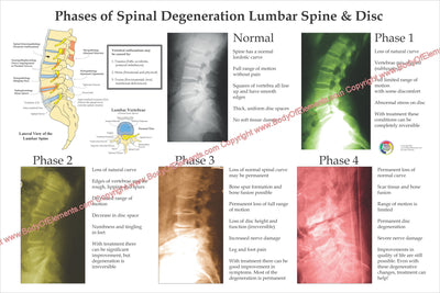 Spinal Degeneration Subluxation Poster Lumbar Spine