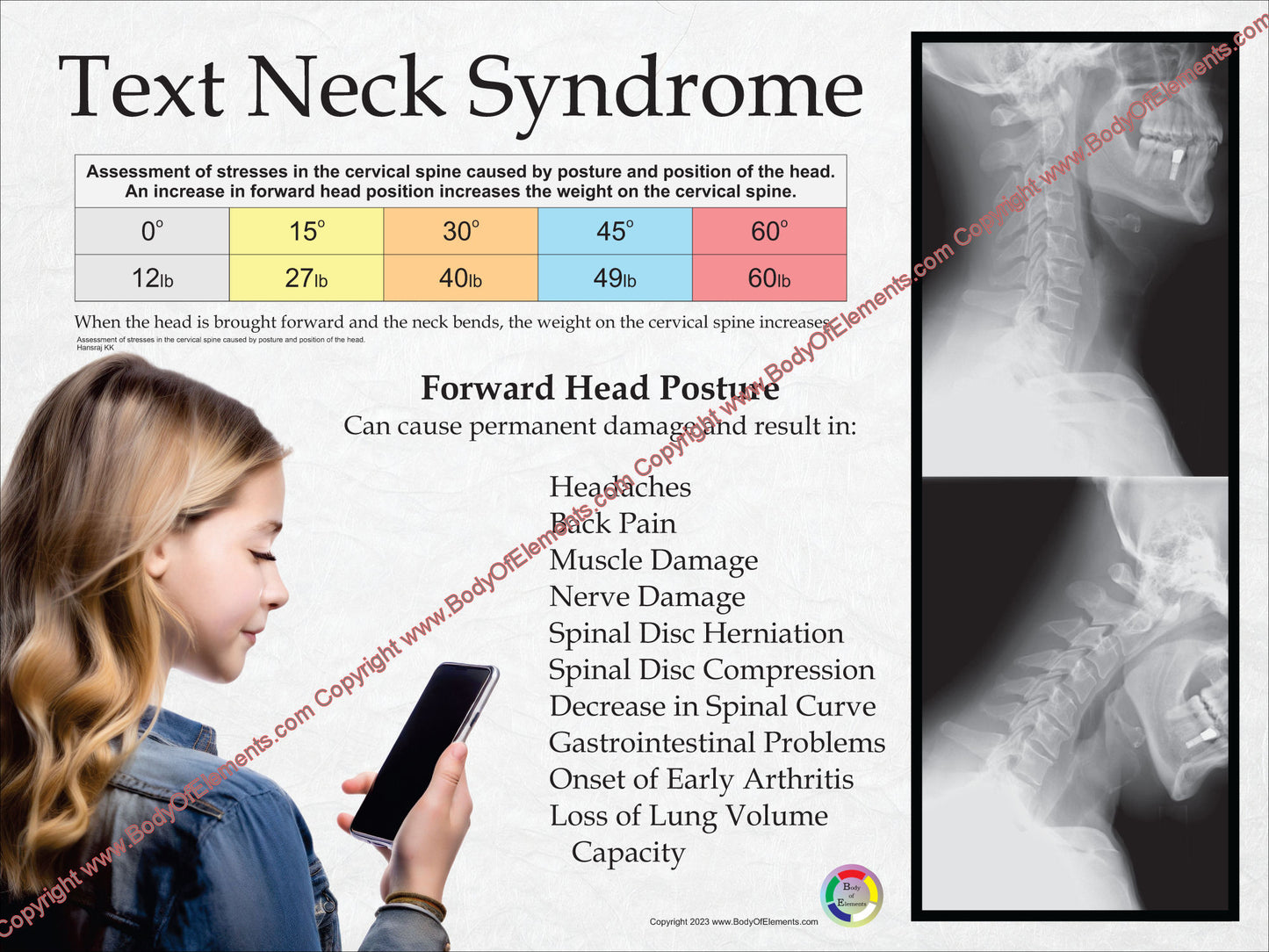 Forward head position pain texting chart.