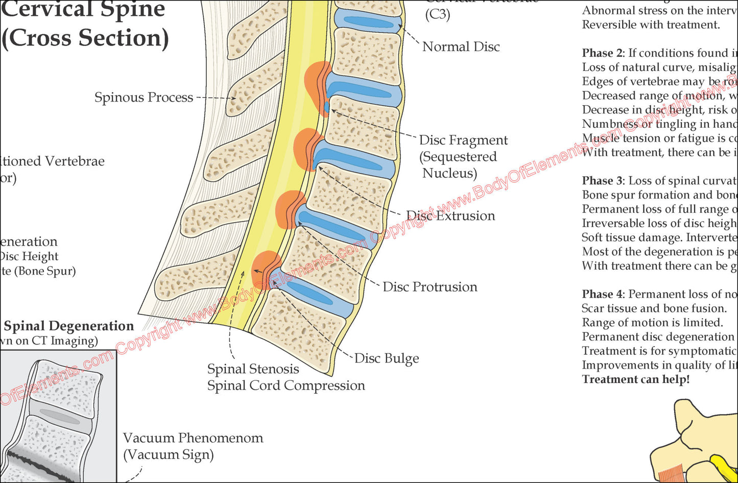 Spinal Degeneration Disc Herniation Poster
