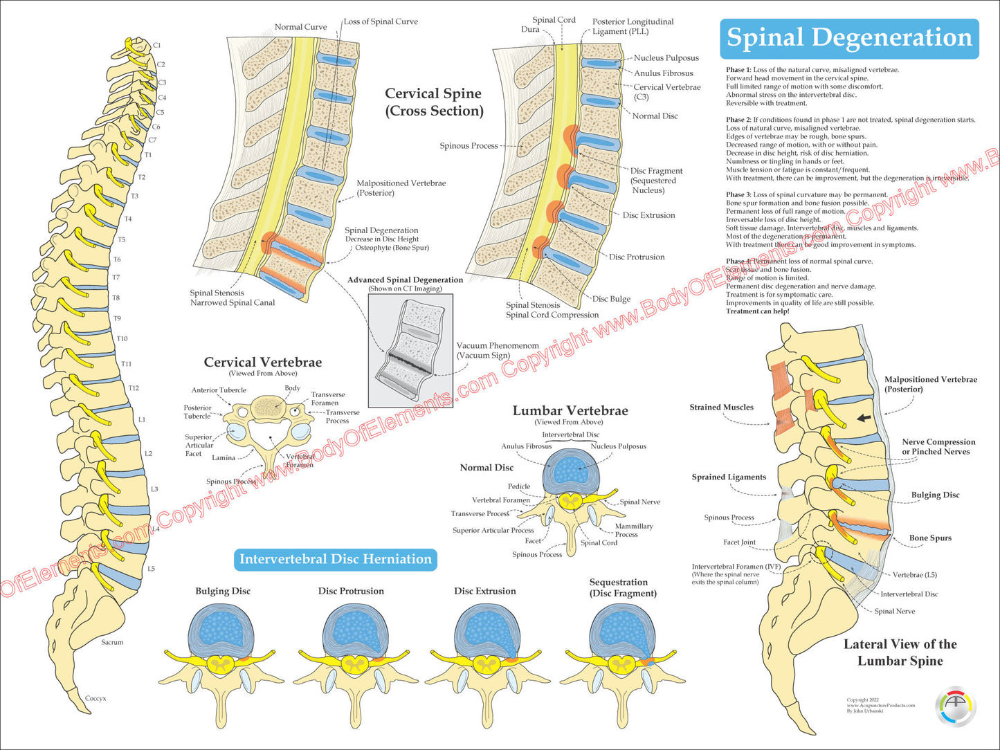 Spinal Degeneration Disc Herniation Poster