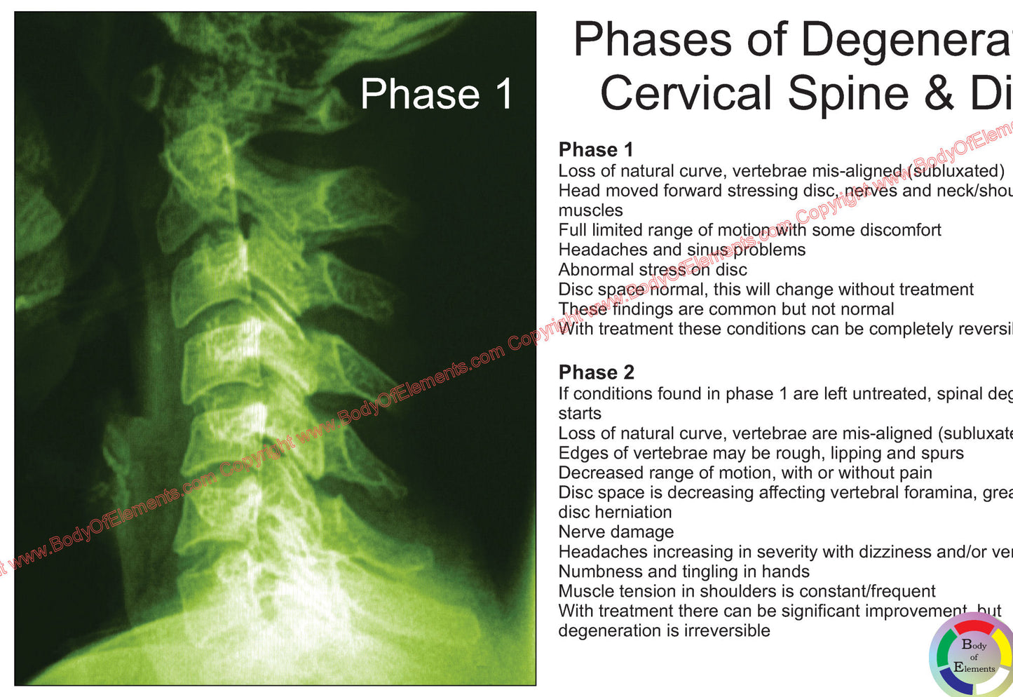 Cervical spine degeneration changes chart