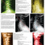 Phases of degeneration cervical spine and disc