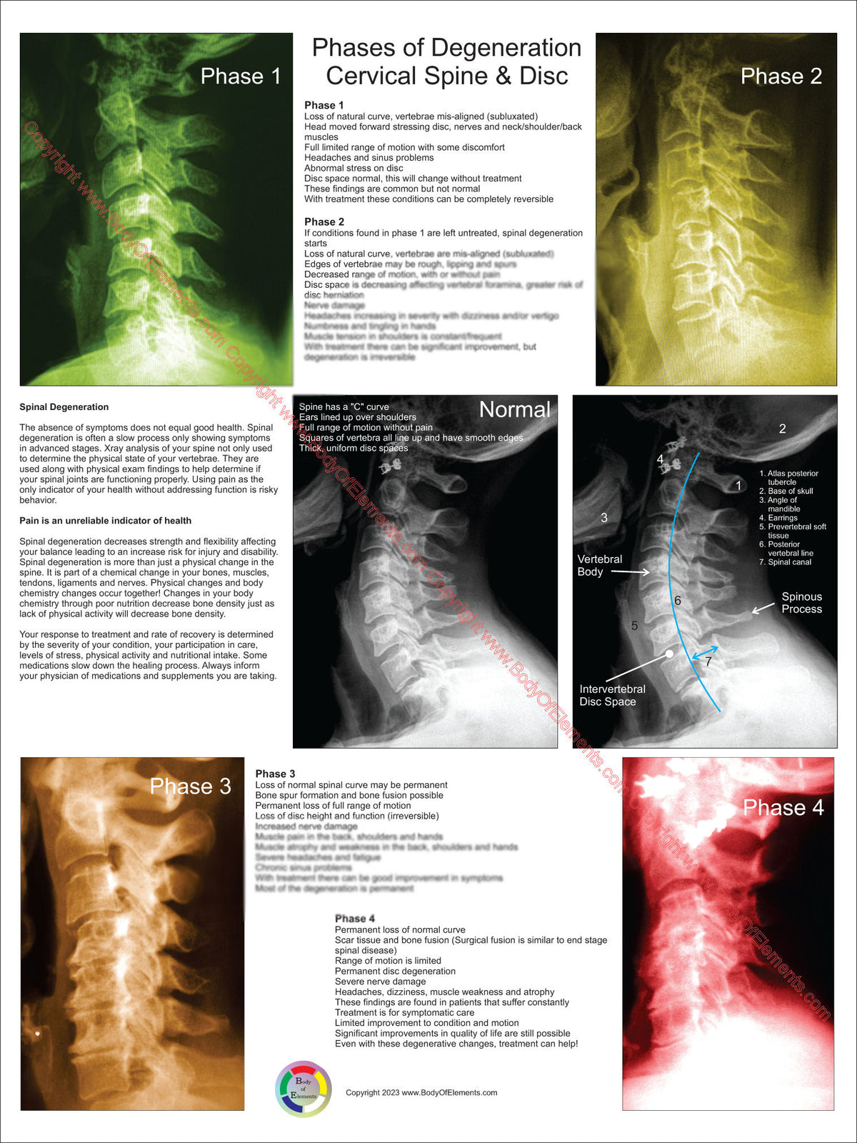 Disc Phase Cervical Spinal Degeneration Phases Poster – Body of Elements