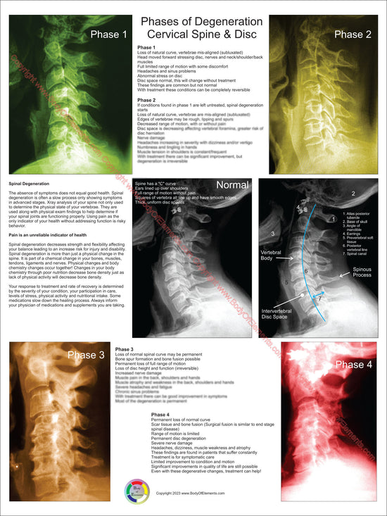 Cervical Spinal Degeneration Phases Poster Body Of Elements