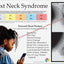 Text neck poster young girl on cellphone.
