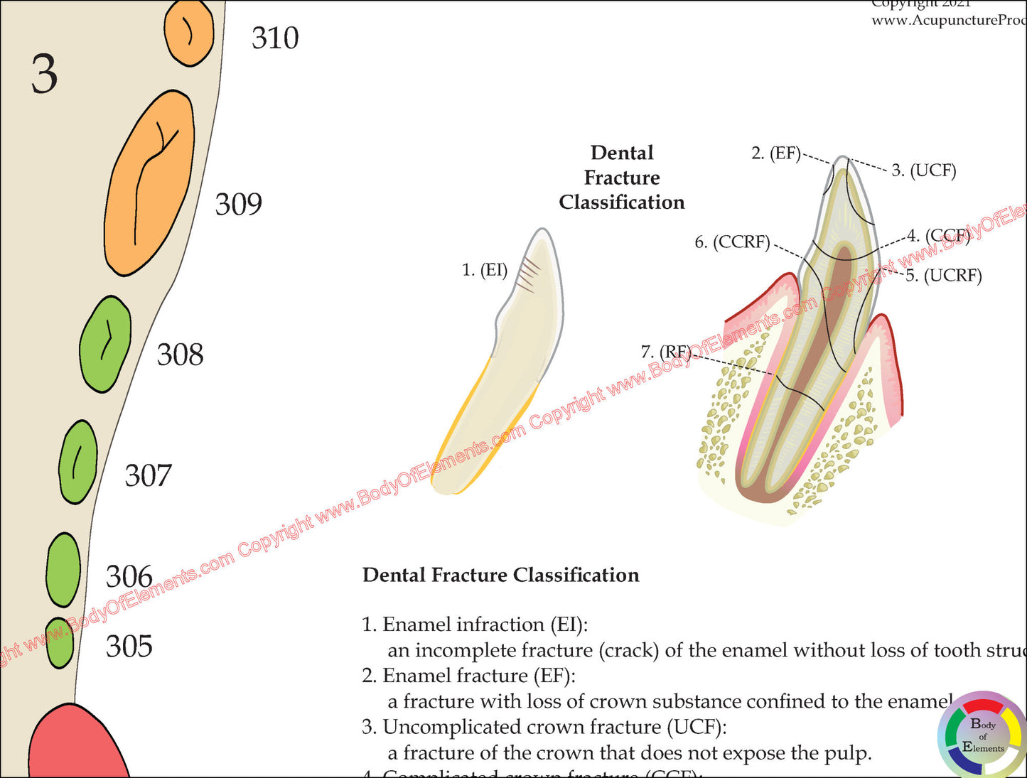 Dog dental fracture classification illustration