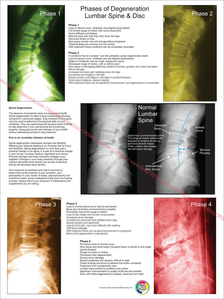 Lumbar Spinal Degeneration Phases Poster – Body of Elements