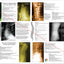 Spinal Degeneration Poster Cervical and Lumbar Spine