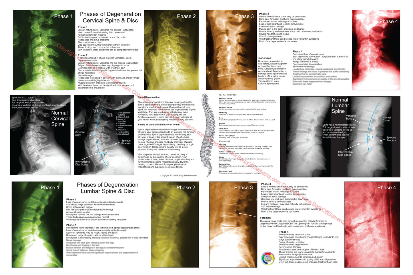Spinal Degeneration Poster Cervical and Lumbar Spine
