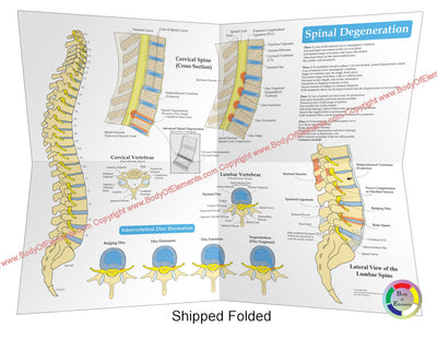 Spinal Degeneration Disc Herniation Poster Folded