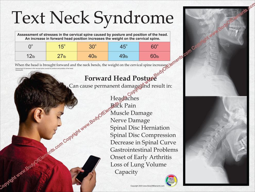Text Neck Syndrome Poster Children – Body of Elements