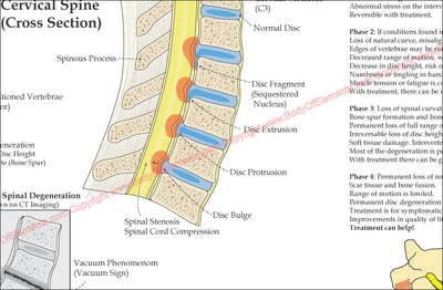 Spinal Degeneration Disc Herniation Poster