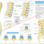 Spinal anatomy and degeneration.