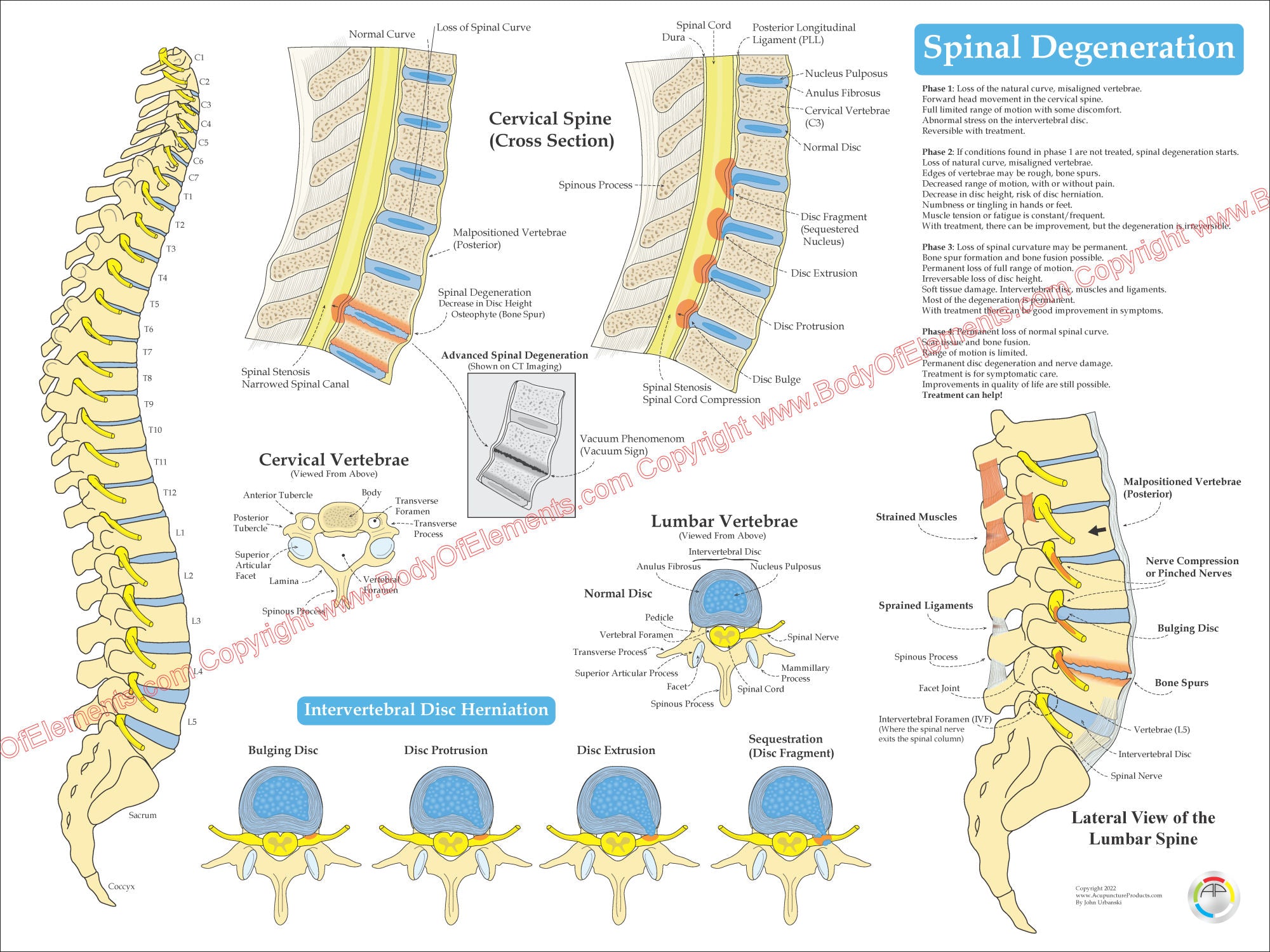 Trunk Disc Body Spinal Degeneration Disc Herniation Poster – Body of Elements