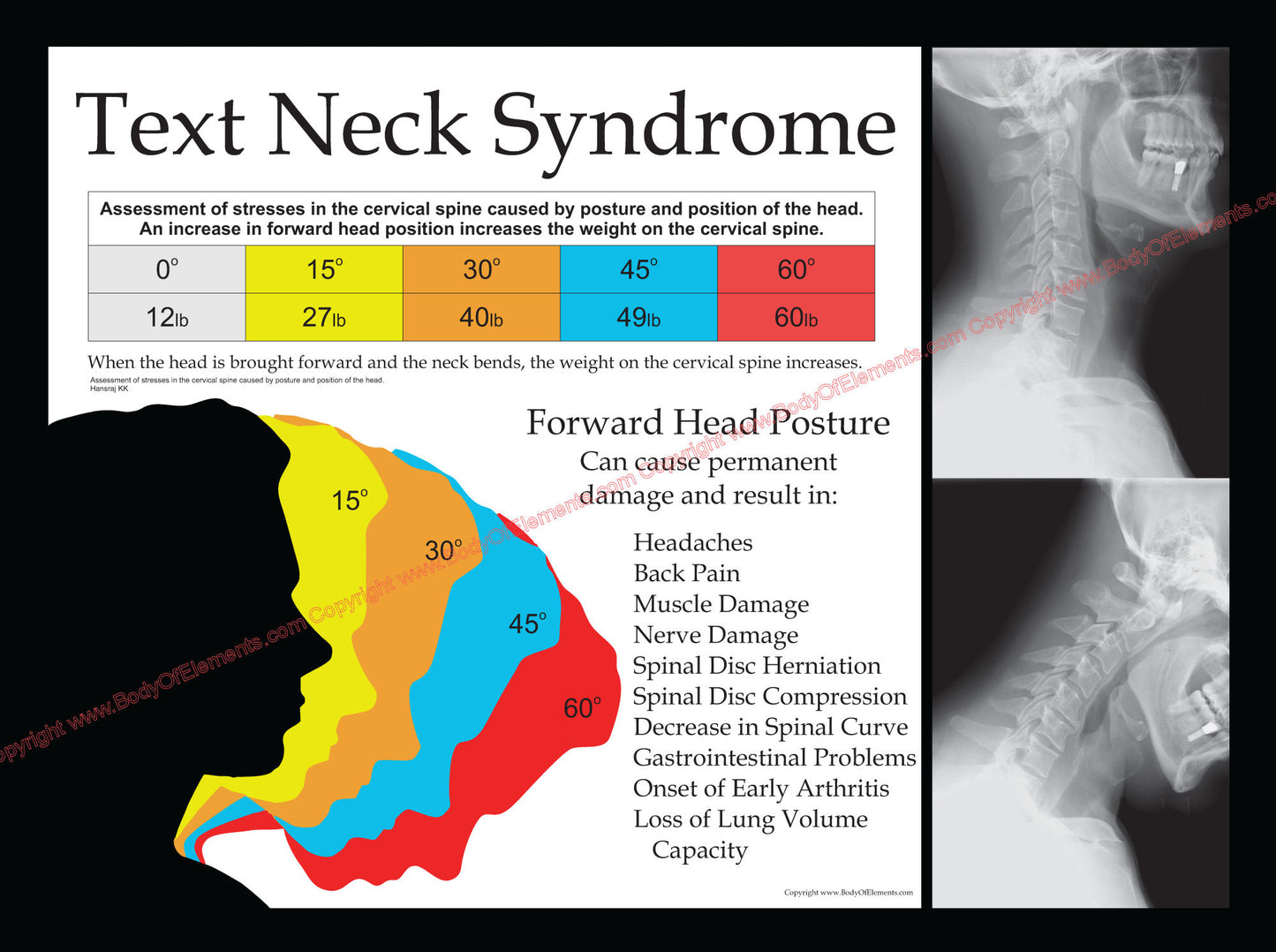 Text Neck Syndrome Chiropractic Poster